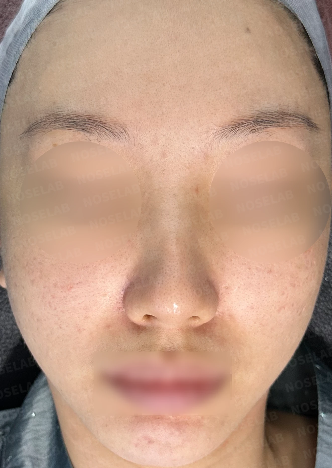 반복 수술 후 긴 코와 높은 시작점의 재수술 방법 — 수술 전 / 수술 직후 0일 직후 사진은 부기가 있는 상태로 최종 결과와 다를 수 있습니다.