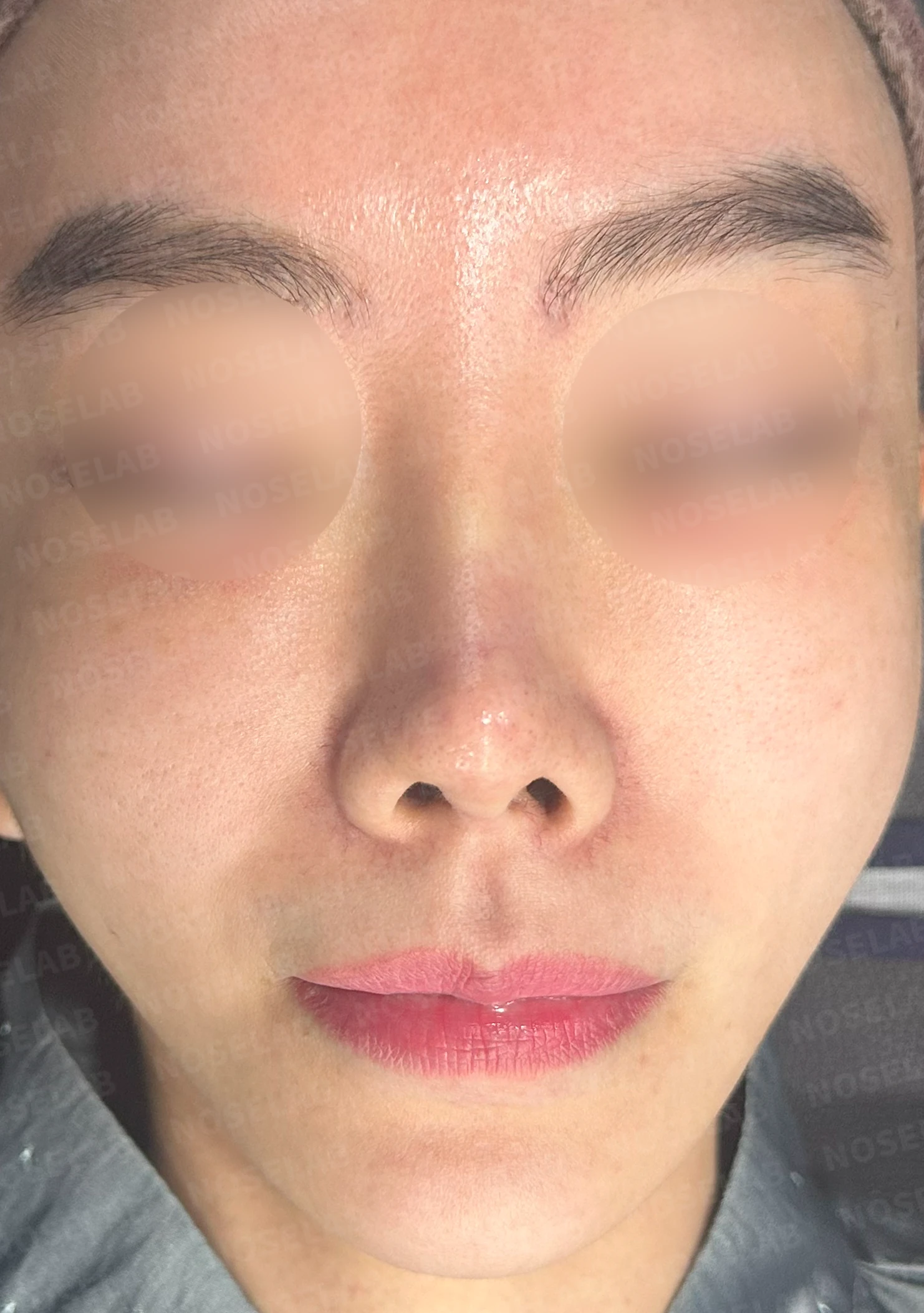 이식한 진피가 반복해서 흡수되는 이유, 재건은 어떻게 하나 — 수술 전 / 수술 직후 0일 직후 사진은 부기가 있는 상태로 최종 결과와 다를 수 있습니다.