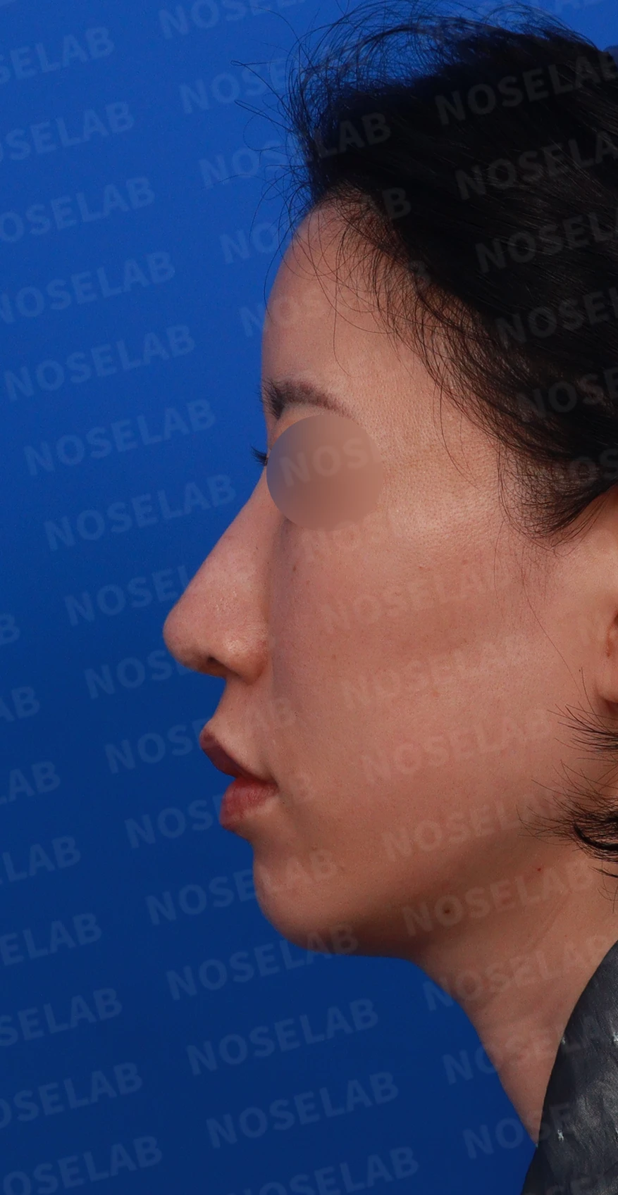 충격을 받은 뒤 코끝에서 소리가 나고 모양이 달라지는 이유와 늑연골 재건 — 디자인 상담 정면 , 좌측 비스듬한 측면 , 측면 사진입니다.