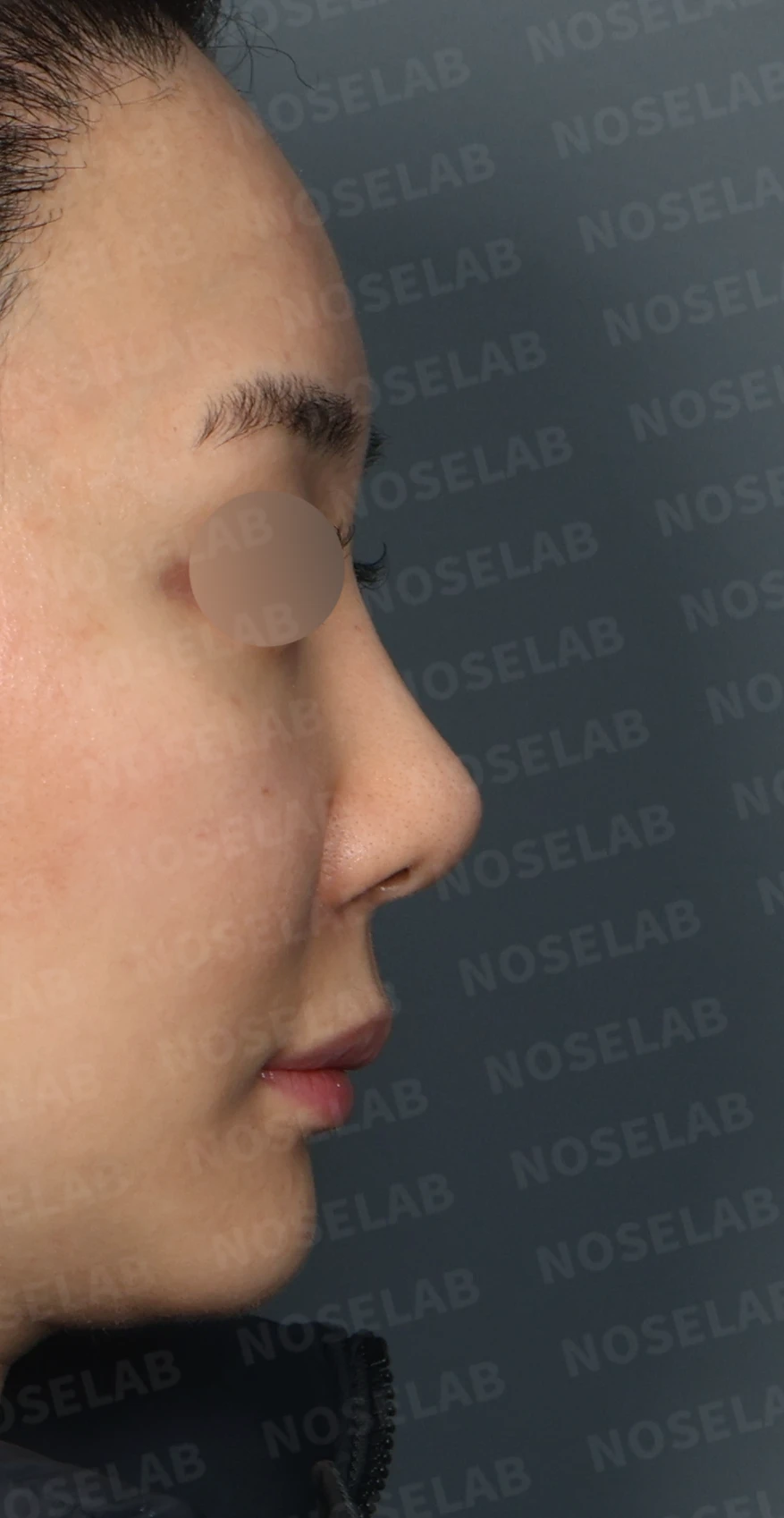 L자 보형물 제거 후 자가 늑연골로 코끝을 교정한 코재수술 — 디자인 상담 우측 측면, 비스듬한 측면, 비공 사진