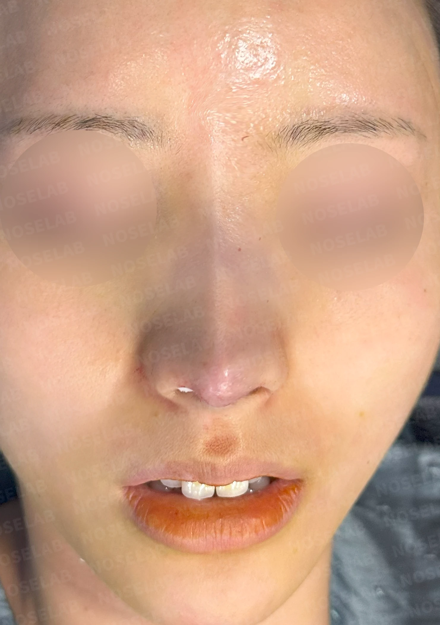 매부리코와 긴 코에 코막힘이 겹치는 이유, 교정은 어떻게 하나 — 수술 전 / 수술 직후 0일 직후 사진은 부기가 있는 상태로 최종 결과와 다를 수 있습니다.
