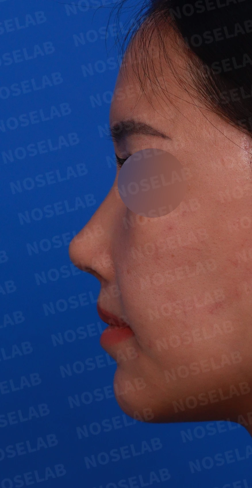 원하는 코 모양과 현재 구조를 함께 살펴보는 수술 계획 — 디자인 상담 정면, 좌측 비스듬한 측면, 측면 사진입니다.