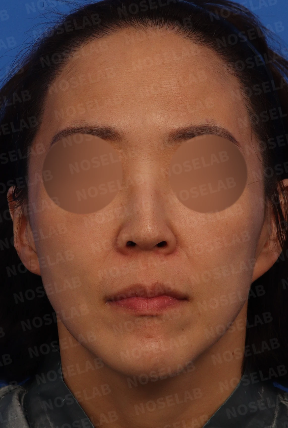 들창코, 매부리코, 휜코까지 한번에 완벽 교정! — 수술전 디자인 상담 정면, 좌측 비스듬한 측면, 측면 사진입니다.