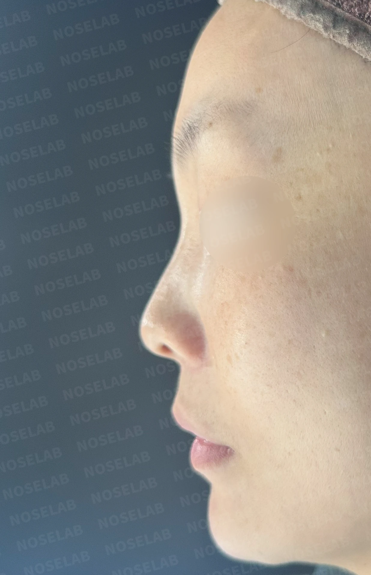 첫 코성형에서 코끝 구조와 콧구멍 노출은 어떻게 다루나 — 수술 전 / 수술 직후 0일 직후 사진은 부기가 있는 상태로 최종 결과와 다를 수 있습니다.