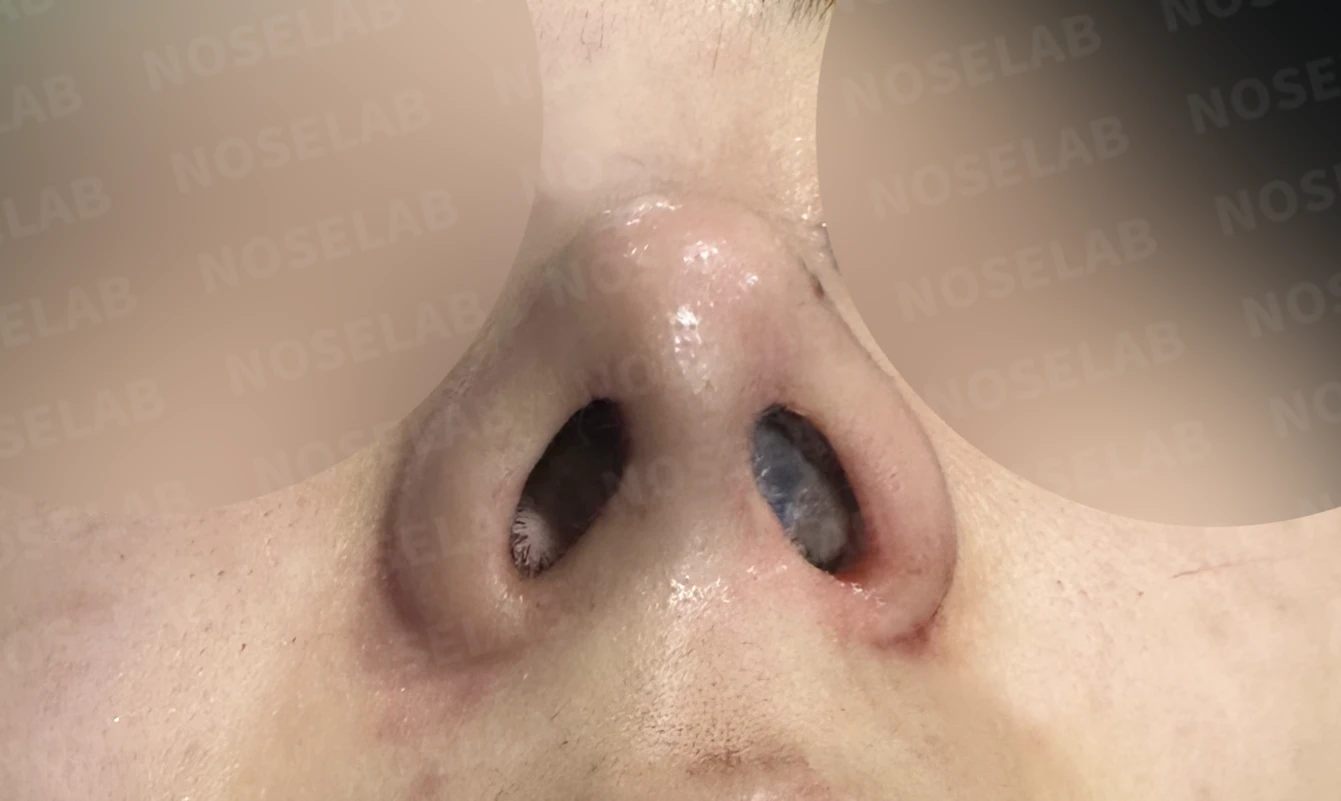 코필러 제거 후 자가늑연골 코성형, 처진 코끝과 메부리코를 자연스럽게 교정 — 전(좌) 직후(후)