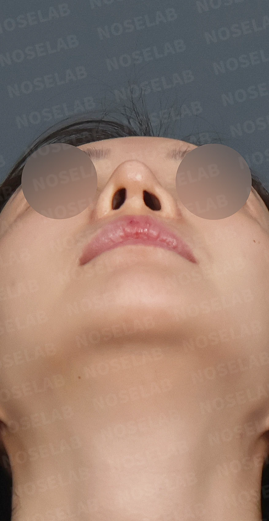 휘어진 코와 퍼진 코끝, 자가늑연골로 세련된 직반라인 완성한 코재수술 — 디자인 상담 우측 측면, 비스듬한 측면, 비공 사진입니다.