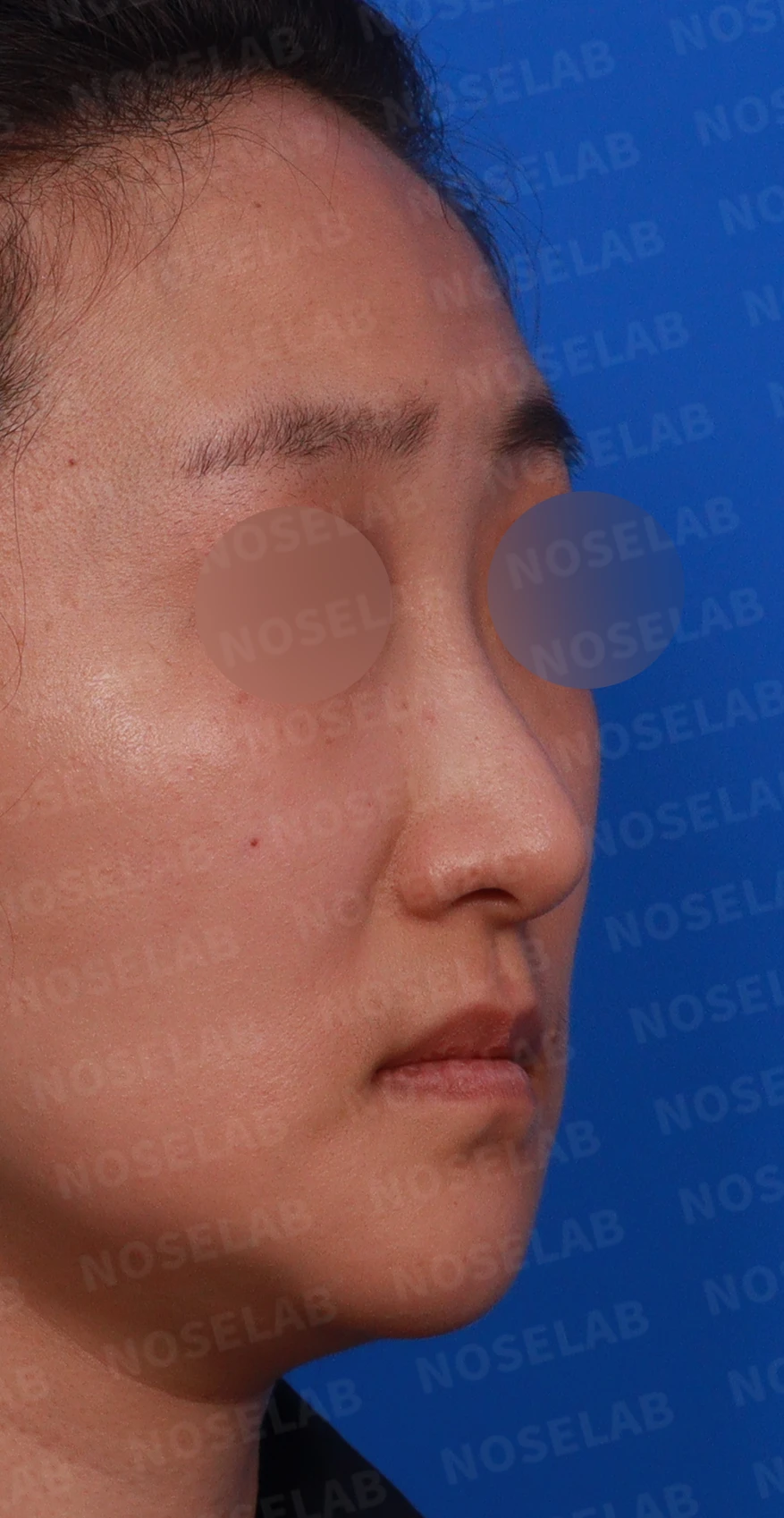코가 한쪽으로 휘어 보이고 밤에 막히는 이유, 비중격 재건과 코막힘 개선 — 디자인 상담 우측 측면 , 비스듬한 측면 , 비공 사진입니다.