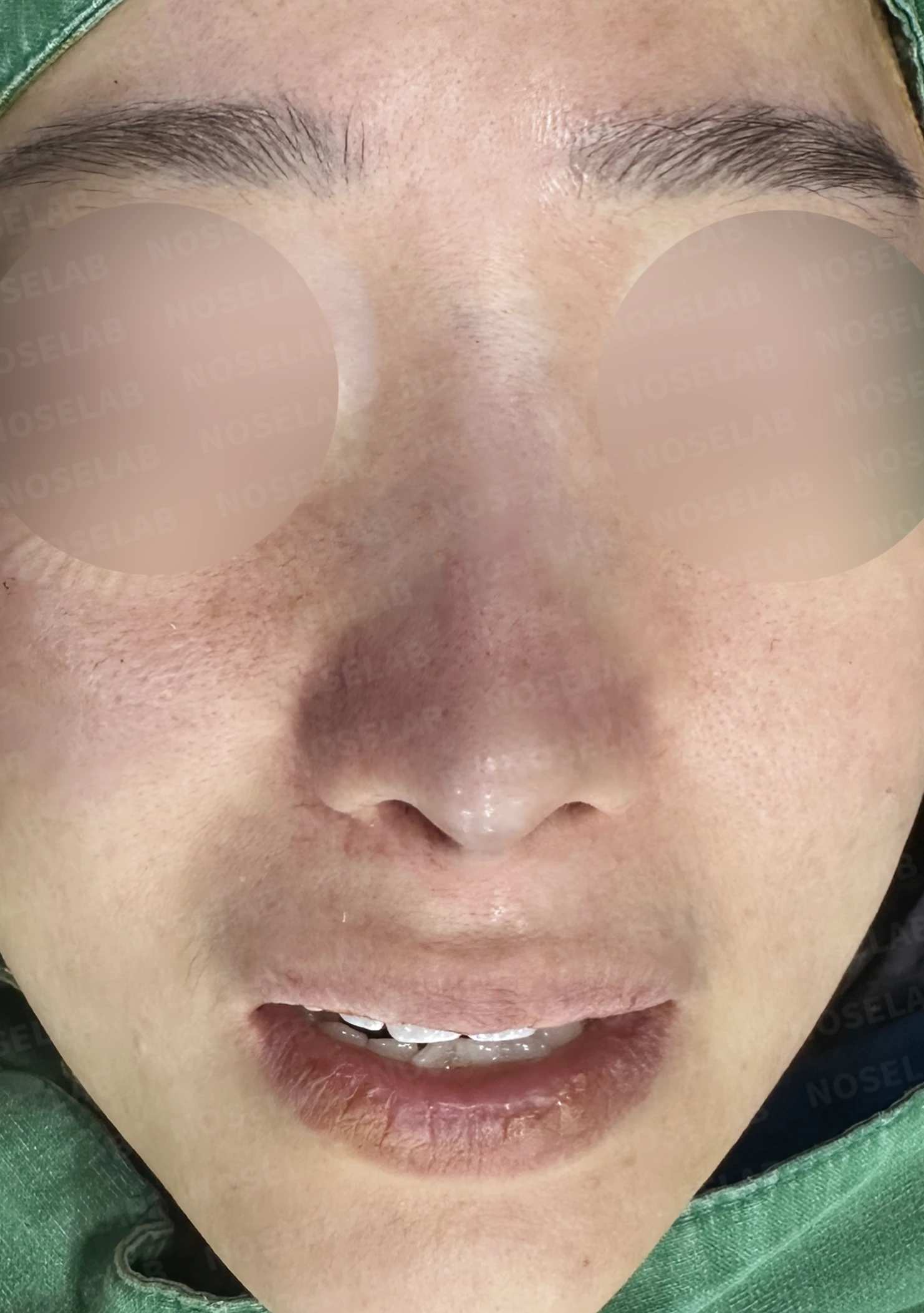 비중격이 한쪽으로 무너지면 코가 휘고 숨이 막히는 이유, 자가늑연골 재건 방법 — 수술 전 / 수술 직후 0일 직후 사진은 부기가 있는 상태로 최종 결과와 다를 수 있습니다.