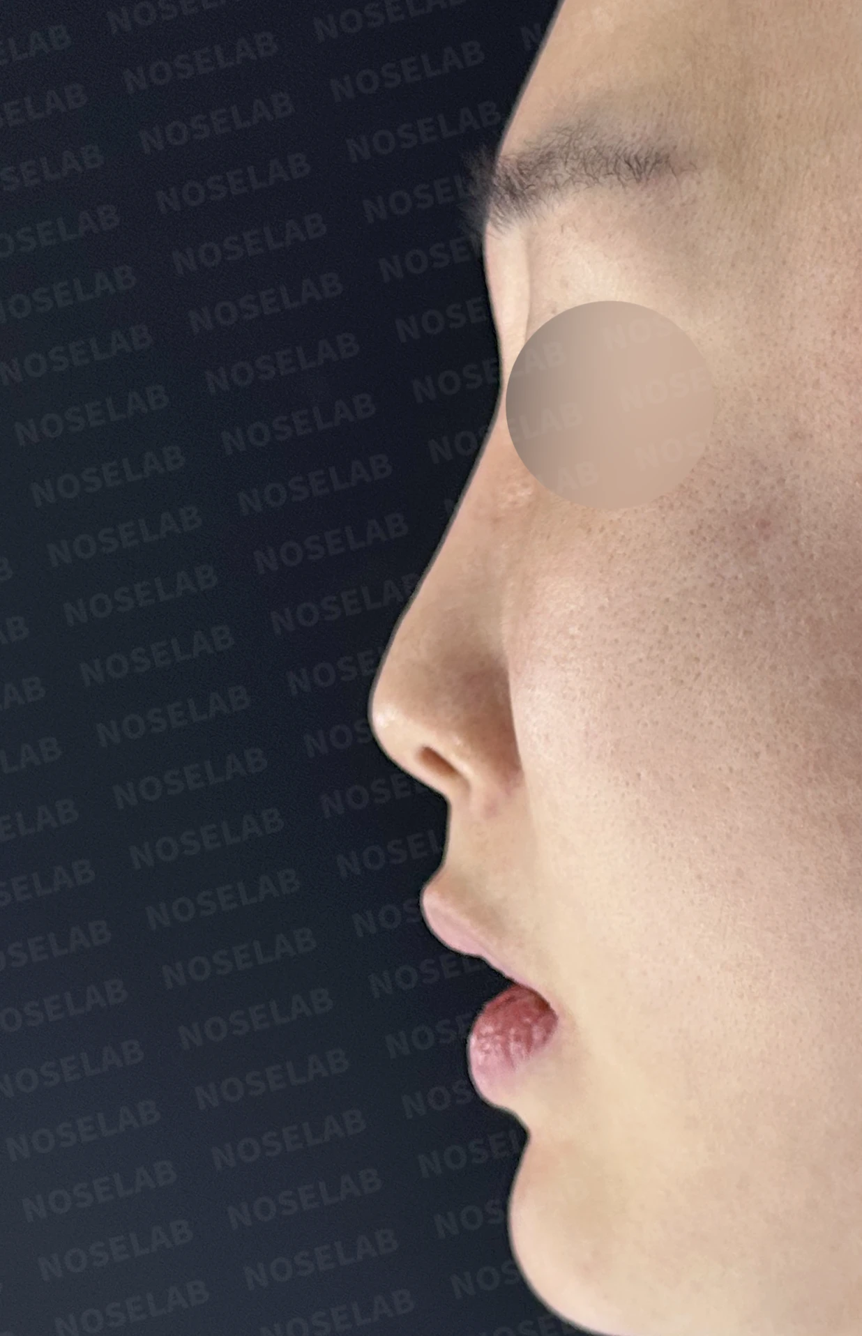 실리콘이 휘고 코가 길어 보이는 이유, 보형물 교체와 늑연골 재건은 어떻게 하나 — 수술 전 / 수술 직후 0일 직후 사진은 부기가 있는 상태로 최종 결과와 다를 수 있습니다.