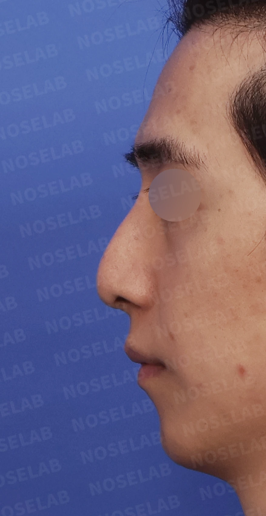 비중격이 한쪽으로 무너지면 왜 코막힘이 심해지는가 — 디자인 상담 정면, 좌측 측면, 비스듬한 측면 사진입니다.