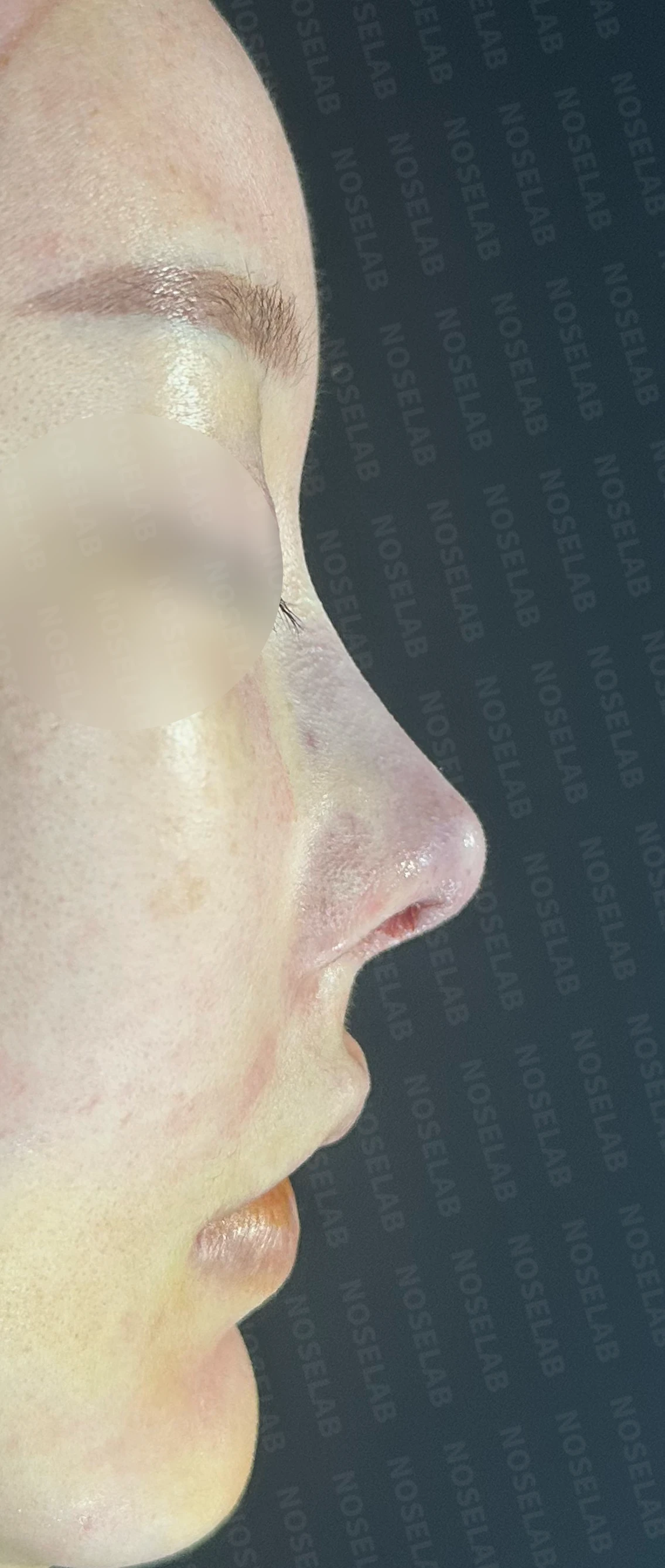 비주 함몰과 복코, 비공 비대칭의 교정 방법 — 수술 직후 0일 정면, 비스듬한 측면, 측면 직후 사진은 부기가 있는 상태로 최종 결과와 다를 수 있습니다.