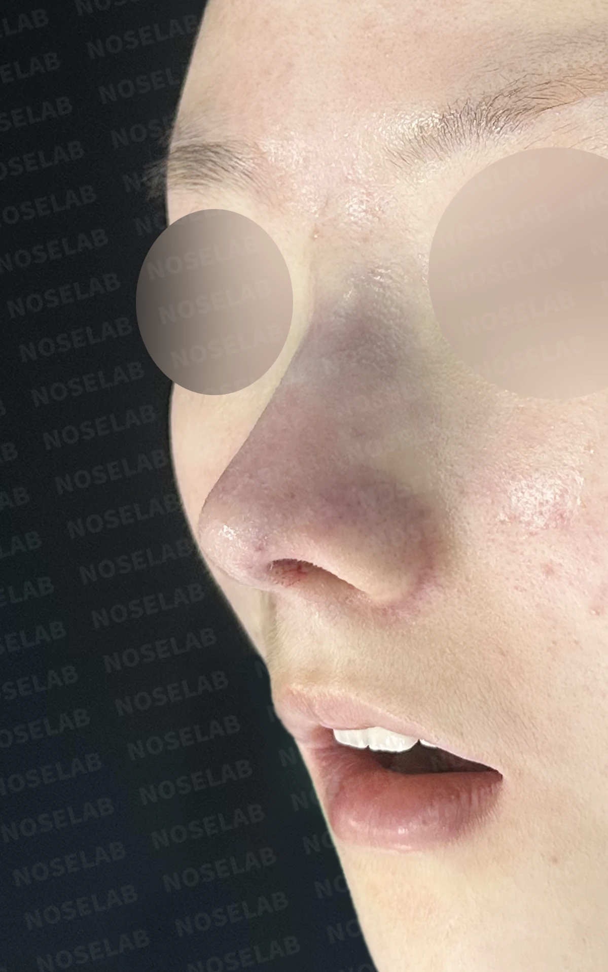 콧대가 퍼져 보이고 코끝이 뭉툭한 이유, 절골술과 자가 늑연골 교정은 어떻게 하나 — 수술 직후 0일 정면, 비스듬한 측면, 측면 사진입니다. 직후 사진은 부기가 있는 상태로 최종 결과와 다를 수 있습니다.