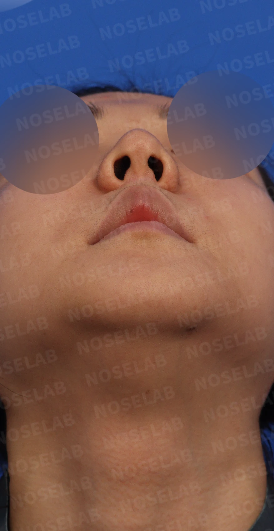 복코와 용코의 비개방 교정 방법 — 수술전 디자인 상담 콧구멍, 우측 측면, 비스듬한 측면 사진입니다.
