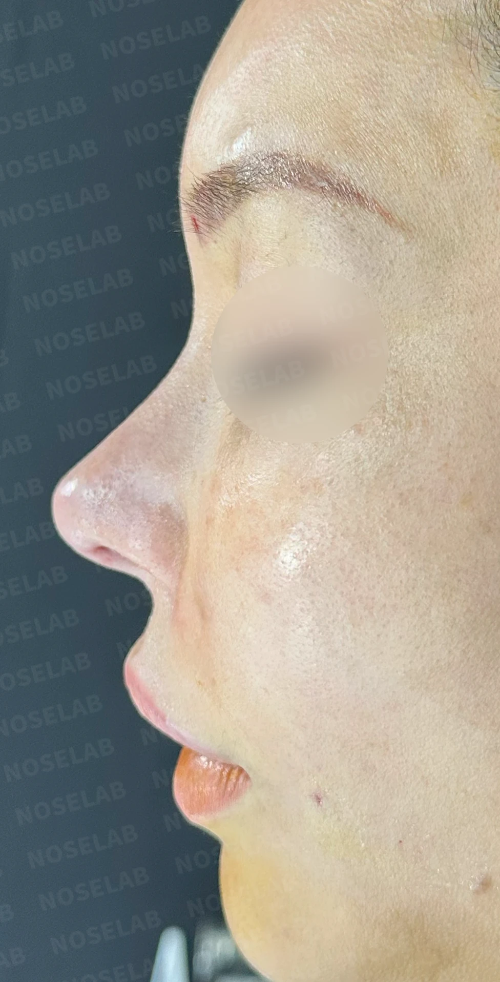 실리텍스 보형물이 비쳐 보이는 이유와 제거 후 재건은 어떻게 하나 — 수술 직후 0일 정면, 비스듬한 측면, 측면 사진입니다. 직후 사진은 부기가 있는 상태로 최종 결과와 다를 수 있습니다.