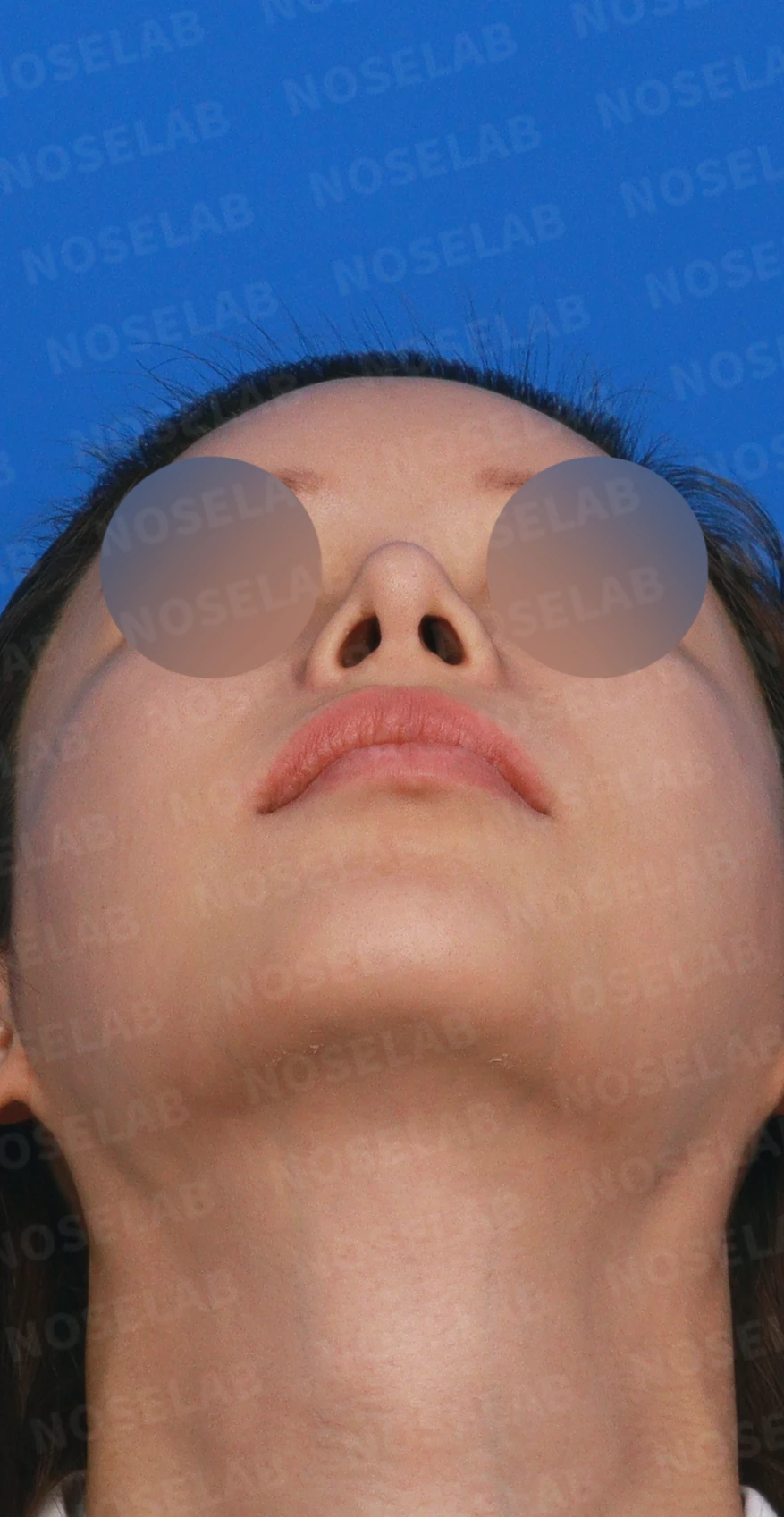 짧고 들린 코를 화려한 직반라인으로 + 무턱교정 — 디자인 상담 우측 측면, 비스듬한 측면, 비공 사진입니다.