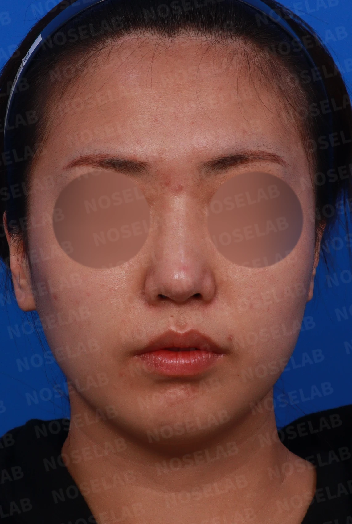 휘어진 코 교정과 비염 개선 - 자가늑연골 재건술 후기 — 디자인 상담 정면, 좌측 측면, 비스듬한 측면 사진