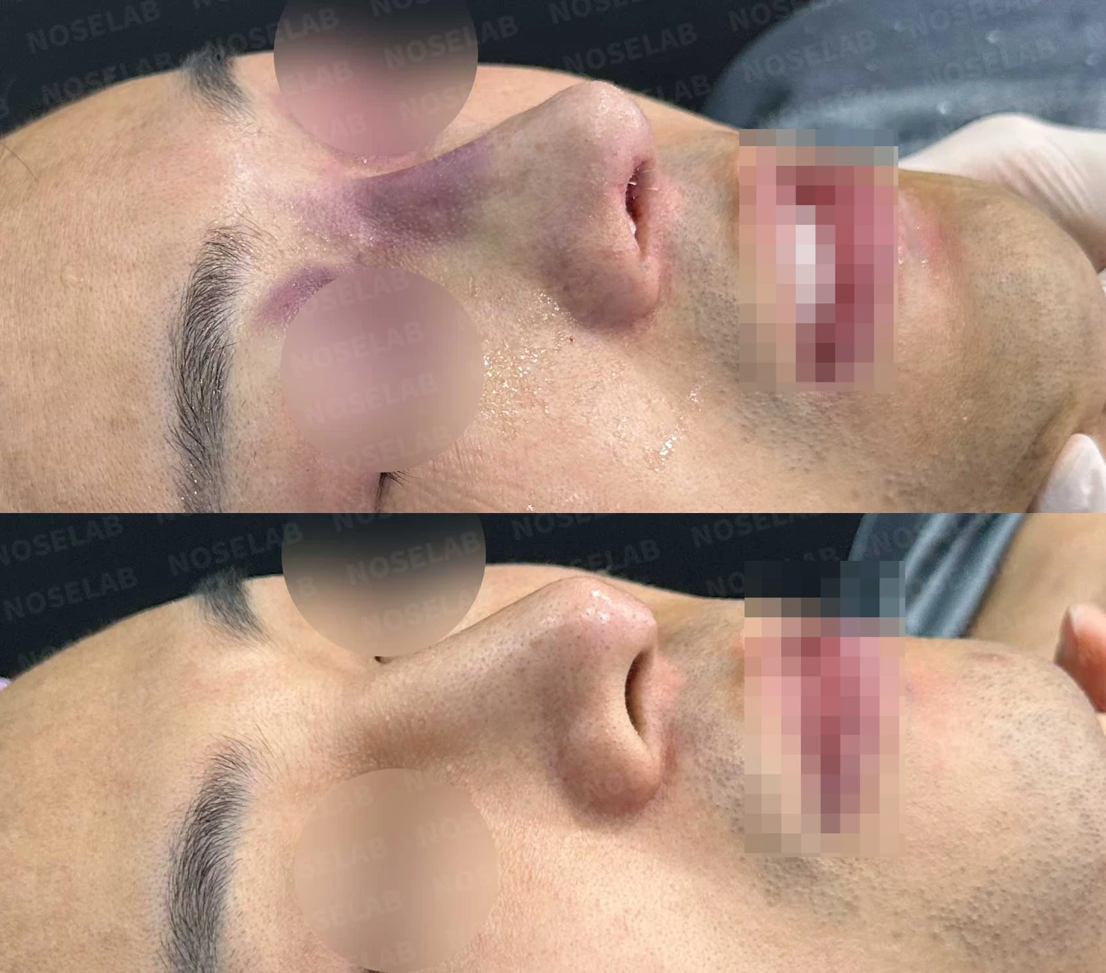 만성 이물 반응과 긴 코의 이물질 제거 및 자가늑연골 재수술 방법 — 수술 전 / 수술 직후 0일 직후 사진은 부기가 있는 상태로 최종 결과와 다를 수 있습니다.