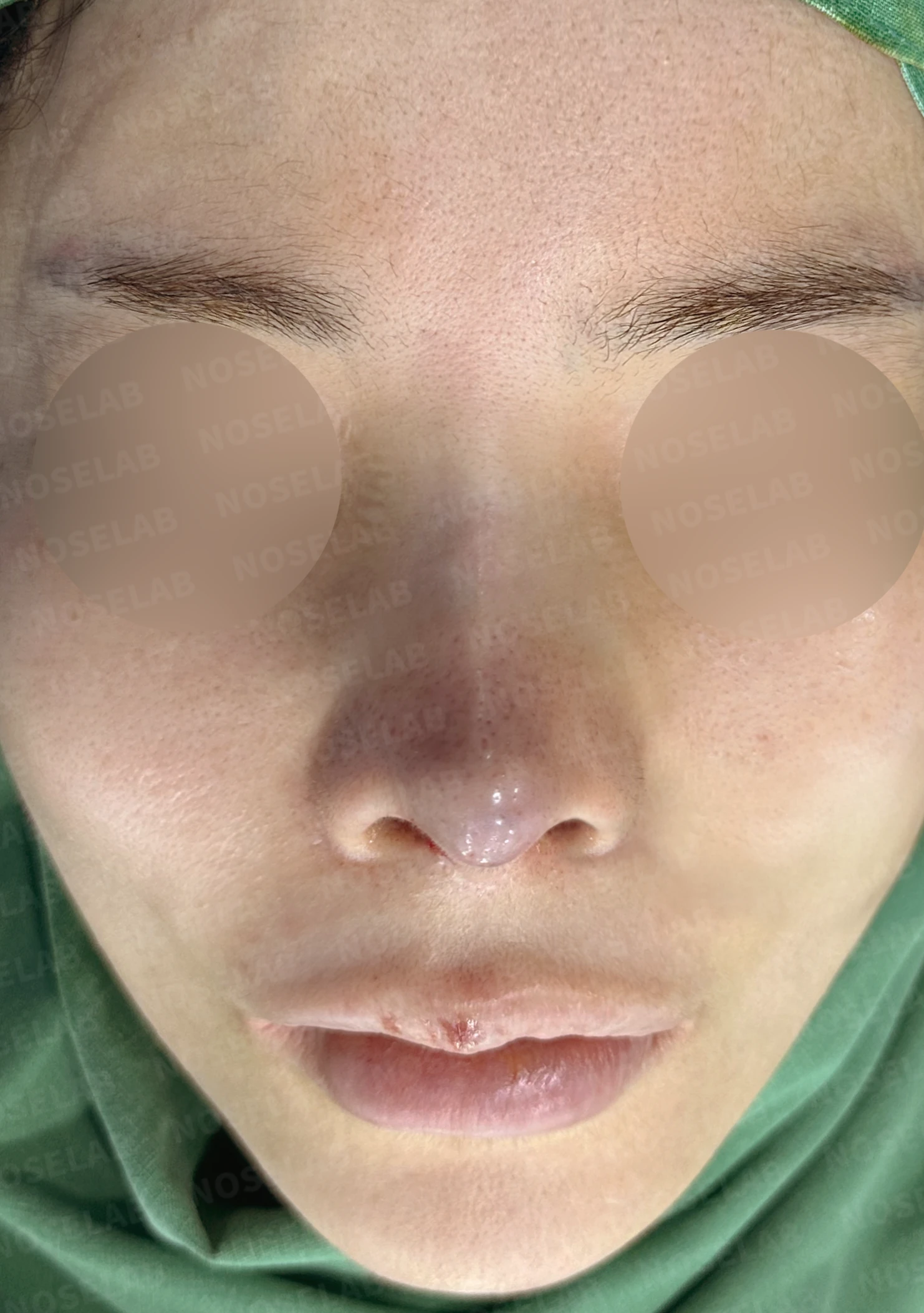 여러 차례 수술 뒤 코막힘이 남는 이유, 비중격과 비밸브 재건은 어떻게 하나 — 수술 전 / 수술 직후 0일 직후 사진은 부기가 있는 상태로 최종 결과와 다를 수 있습니다.