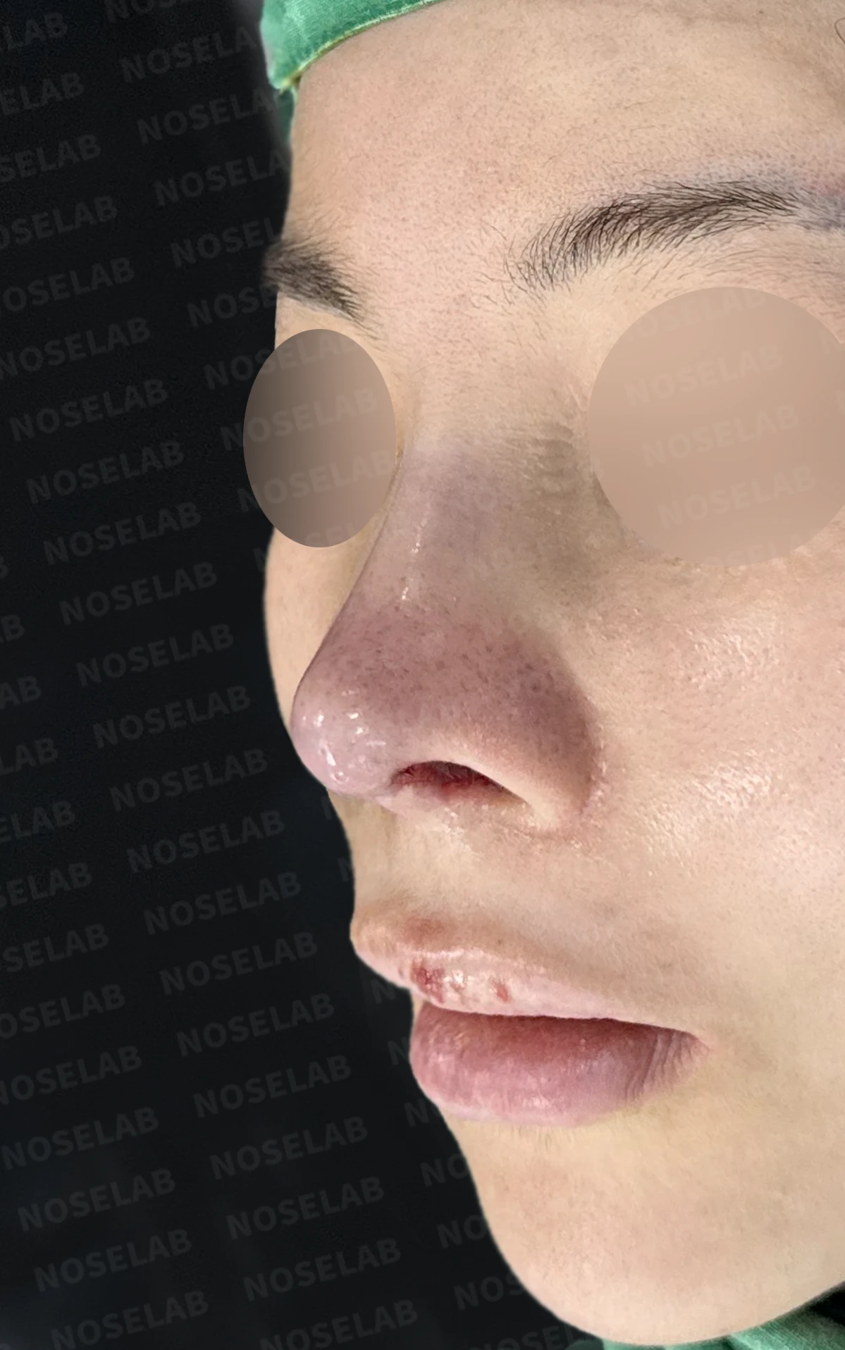 여러 차례 수술 뒤 코막힘이 남는 이유, 비중격과 비밸브 재건은 어떻게 하나 — 수술 직후 0일 정면, 비스듬한 측면, 측면 사진입니다. 직후 사진은 부기가 있는 상태로 최종 결과와 다를 수 있습니다.