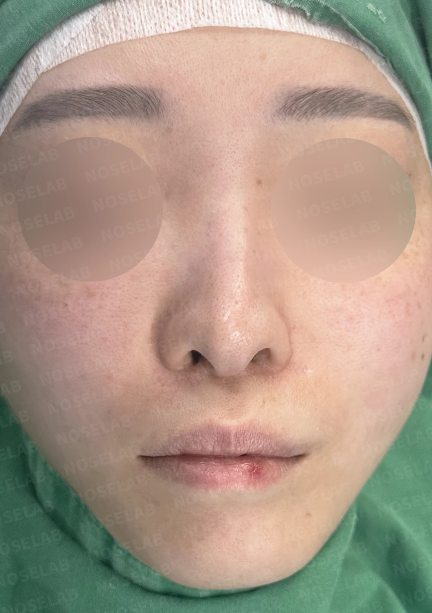 처진 비주 교정, 휜 코와 비공 비대칭까지 완벽하게 — 전(좌) 직후(후)