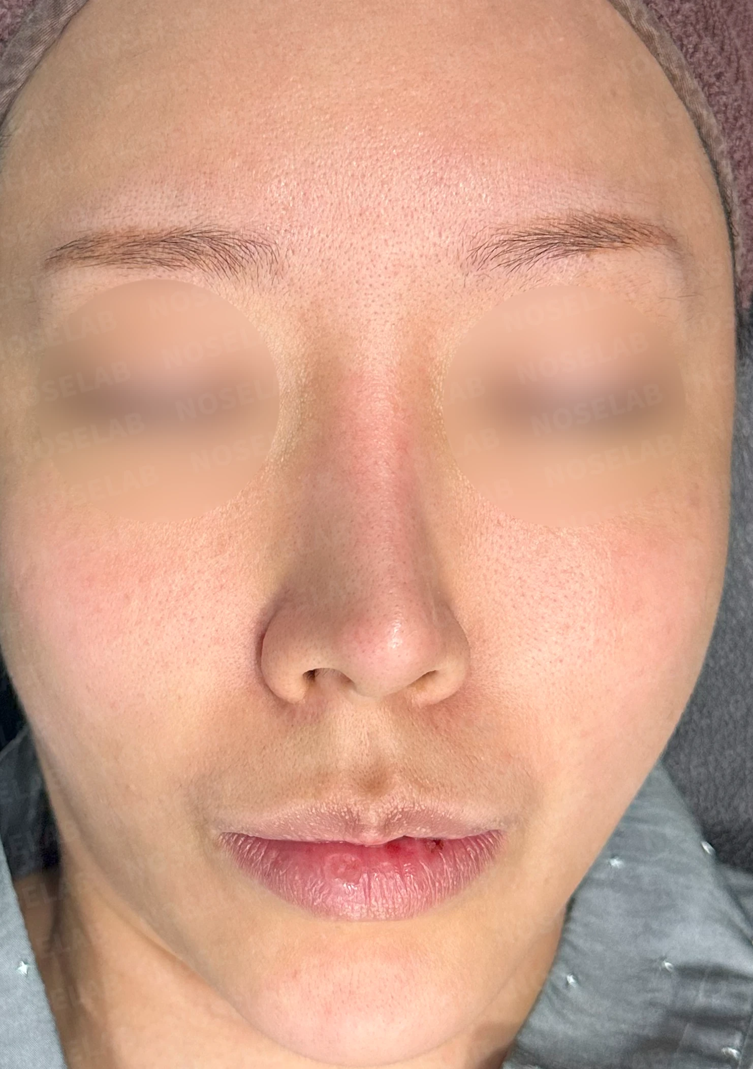 휜코와 콧구멍 비대칭, 호흡을 함께 고려한 교정 방법 — 수술 전 / 수술 직후 0일 직후 사진은 부기가 있는 상태로 최종 결과와 다를 수 있습니다.
