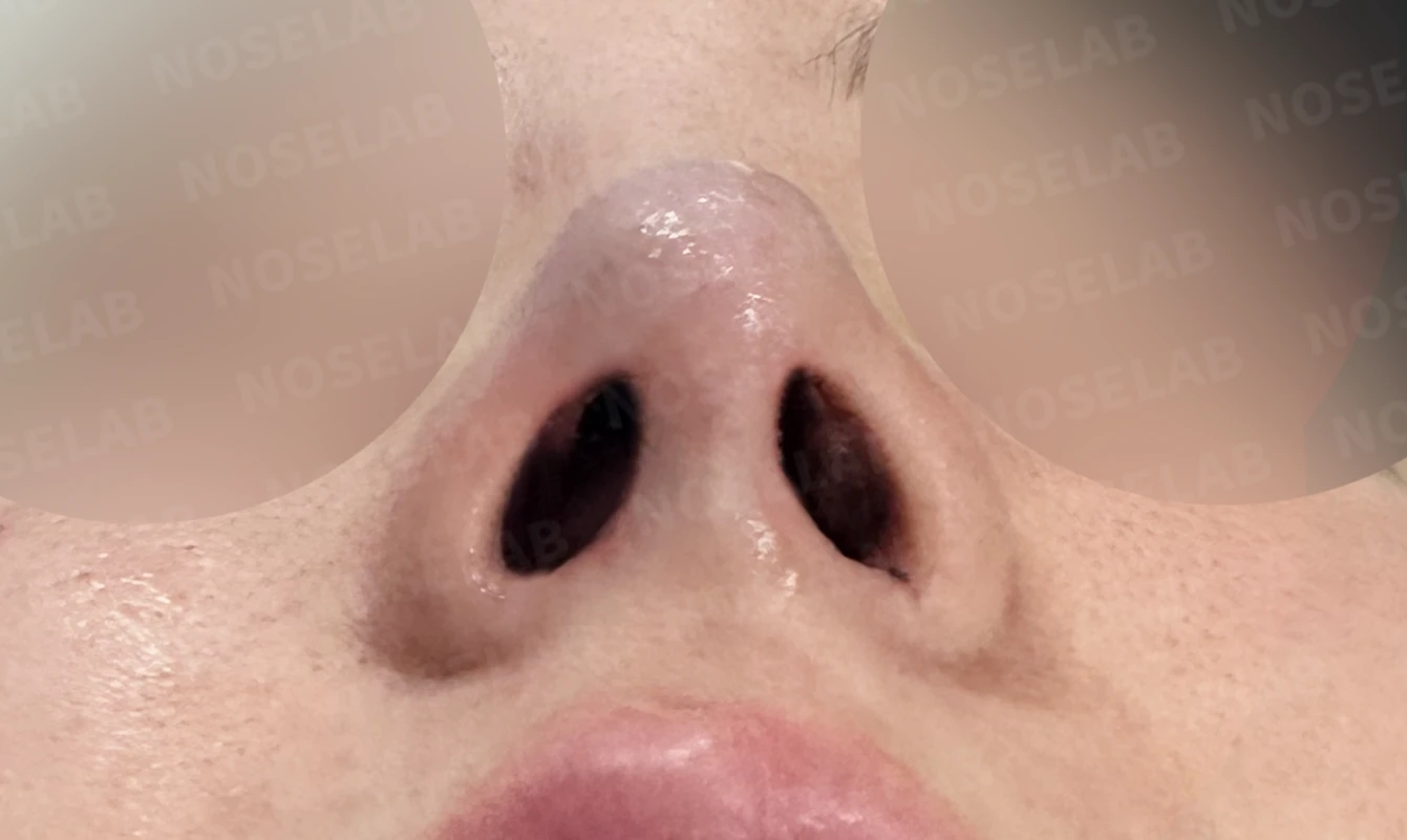 코가 길어 보이고 비주가 휘는 이유, 비중격 연장과 재건은 어떻게 하나 — 수술 직후 0일 비공 사진 직후 사진은 부기가 있는 상태로 최종 결과와 다를 수 있습니다.
