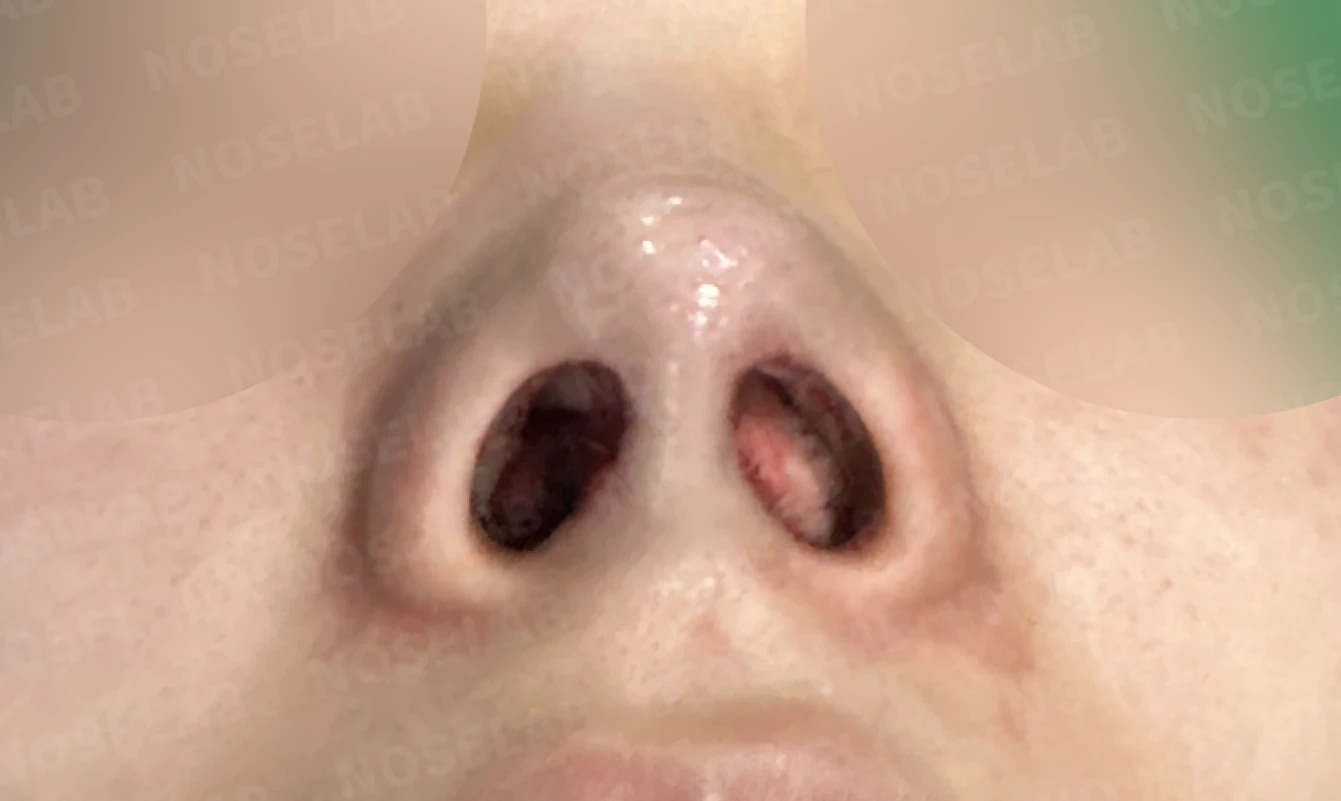 길고 처진 코, 휜코 교정과 코막힘까지 한 번에 해결한 재수술 사례 — 전(좌) 직후(후)