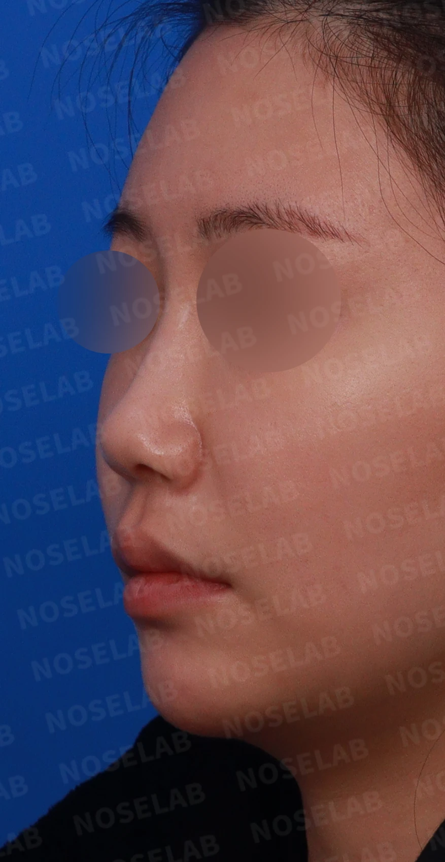 필러와 실이 남아 있는 코, 제거 후 늑연골 재건은 어디까지 가능한가 — 디자인 상담 정면, 좌측 측면, 비스듬한 측면 사진