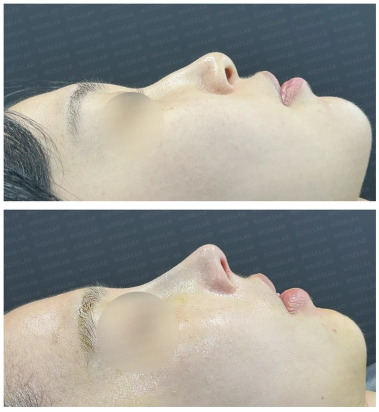 긴 화살코에서 자연스러운 곡선미로 - 맞춤형 코성형 — 전후 비교