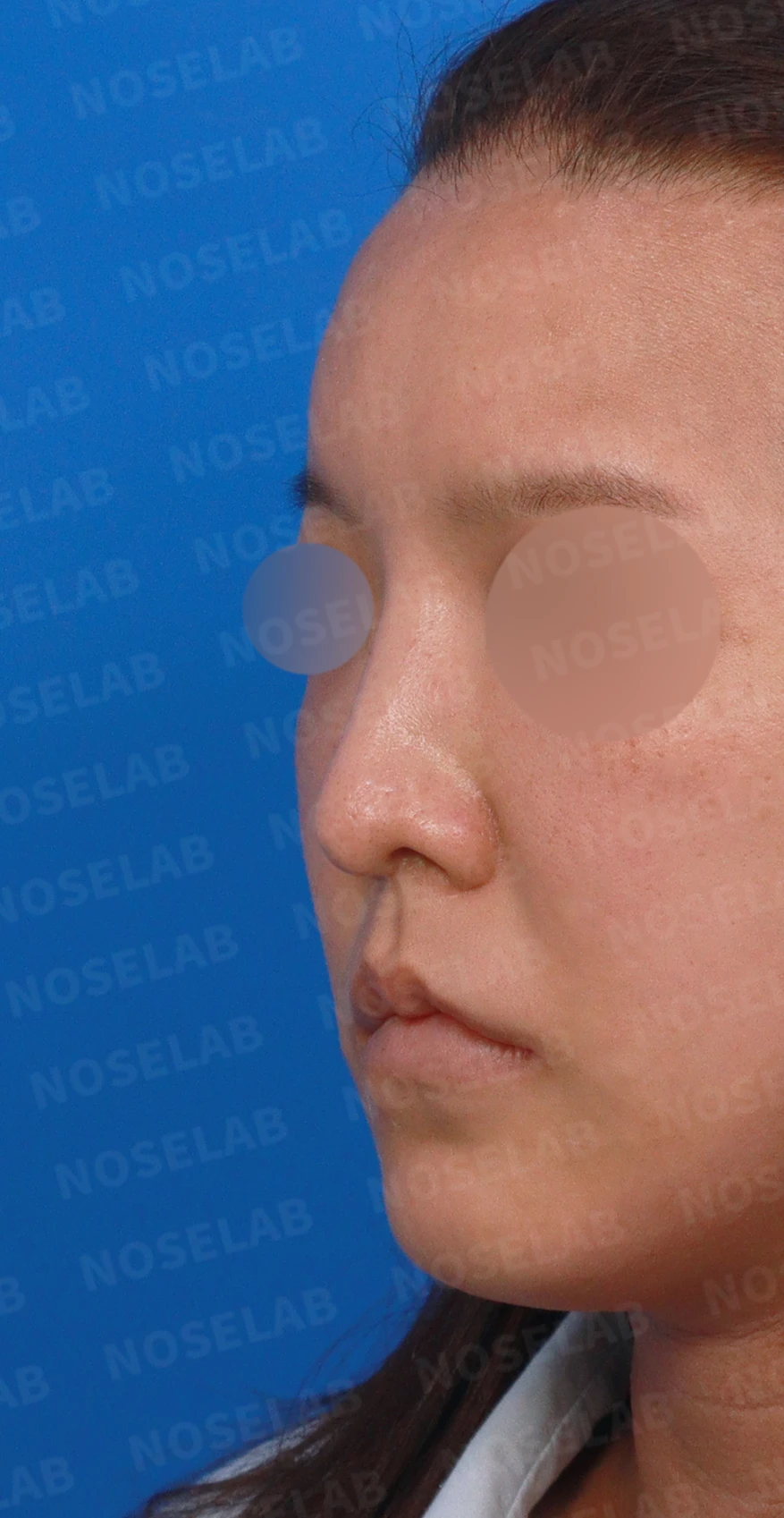휜 코 교정과 코막힘 개선, 두 마리 토끼를 잡은 성공 사례 — 디자인 상담 정면, 좌측 측면, 비스듬한 측면 사진입니다.
