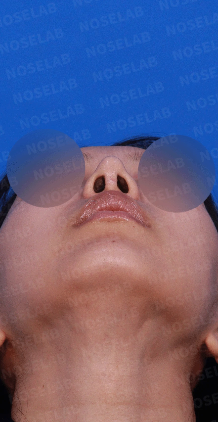여러 번 수술한 코에 연골이 비치는 이유와 점막·구조 복원 방법 — 디자인 상담 우측 측면 , 비스듬한 측면 , 비공 사진입니다.