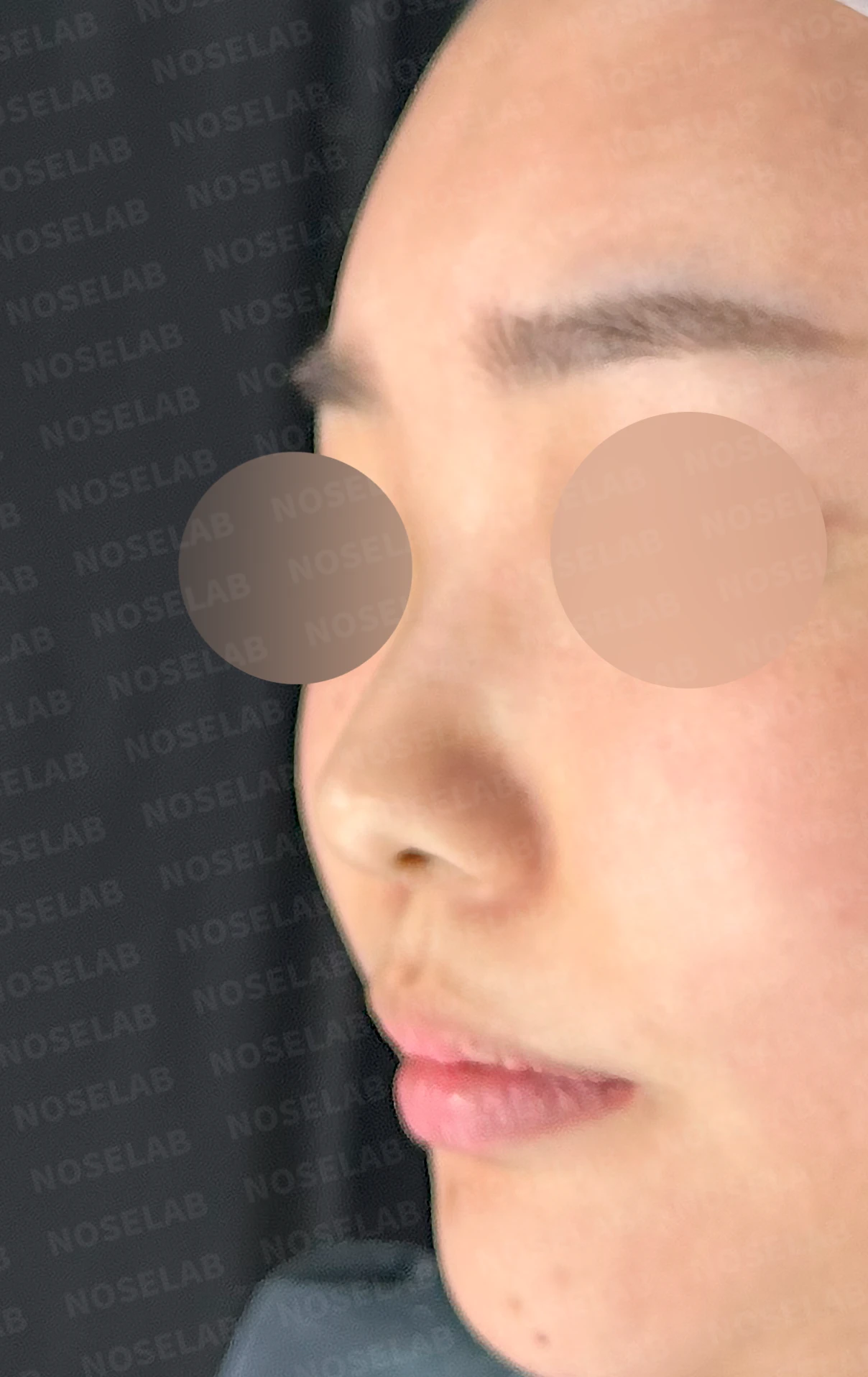 비염 수술을 받았는데도 코막힘이 돌아오는 이유, 구조 교정은 어떻게 하나 — 수술 전 / 수술 직후 0일 직후 사진은 부기가 있는 상태로 최종 결과와 다를 수 있습니다.
