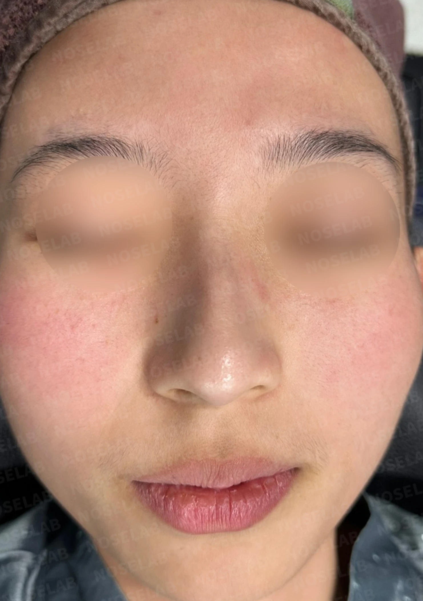 외상 뒤 심해진 매부리와 휜 코, 변화를 최소로 두는 교정 방법 — 수술 전 / 수술 직후 0일 직후 사진은 부기가 있는 상태로 최종 결과와 다를 수 있습니다.