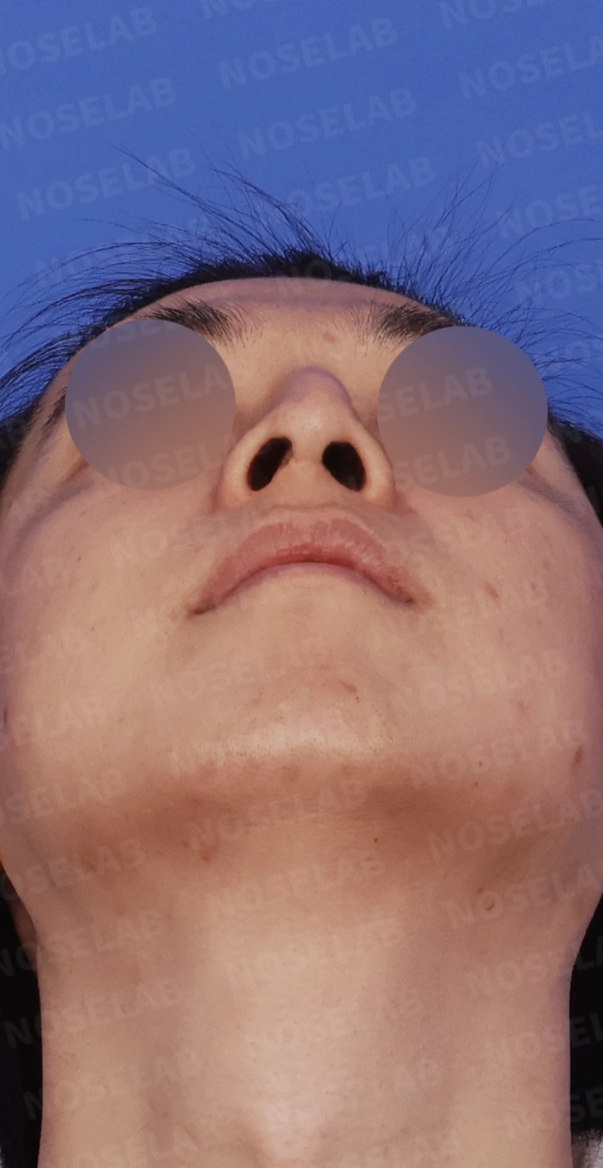 비중격이 한쪽으로 무너지면 왜 코막힘이 심해지는가 — 디자인 상담 우측 측면, 비스듬한 측면, 비공 사진입니다.