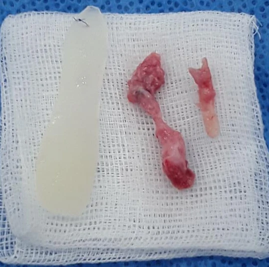 코끝이 찝히고 비주가 함몰되는 이유, 메드포어 제거와 재건은 어떻게 하나 — 제거된 실리콘 보형물, 이물질, 메드포어 사진