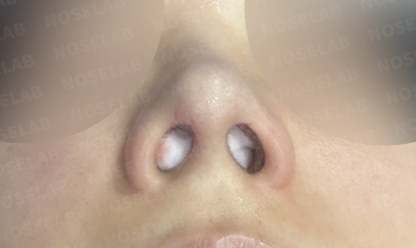 L자 보형물 제거 후 자가 늑연골로 코끝을 교정한 코재수술 — 직후 비공 사진