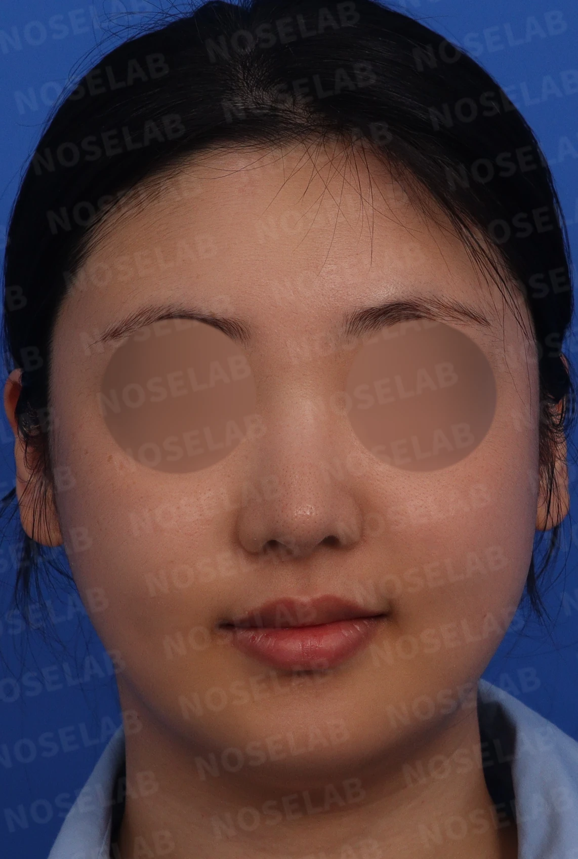 퍼진 코 개선과 콧구멍 비대칭 교정 방법 — 정면 사진 평가