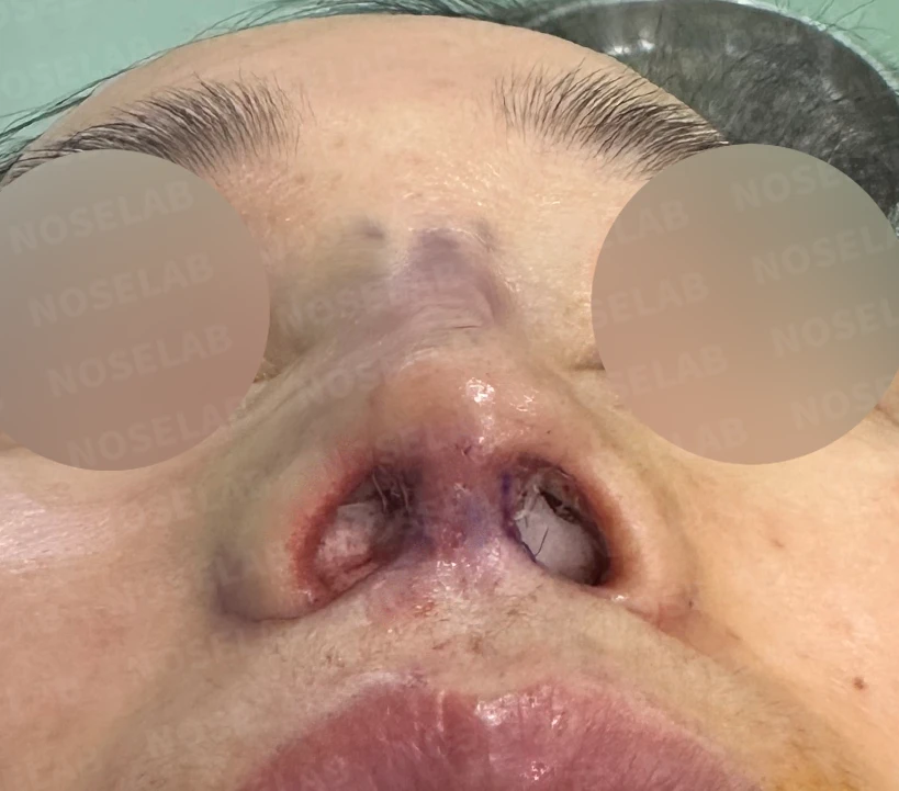인중축소술 교정과 자가진피 제거 가능한가요? — 수술 전 / 수술 직후 0일 직후 사진은 부기가 있는 상태로 최종 결과와 다를 수 있습니다.