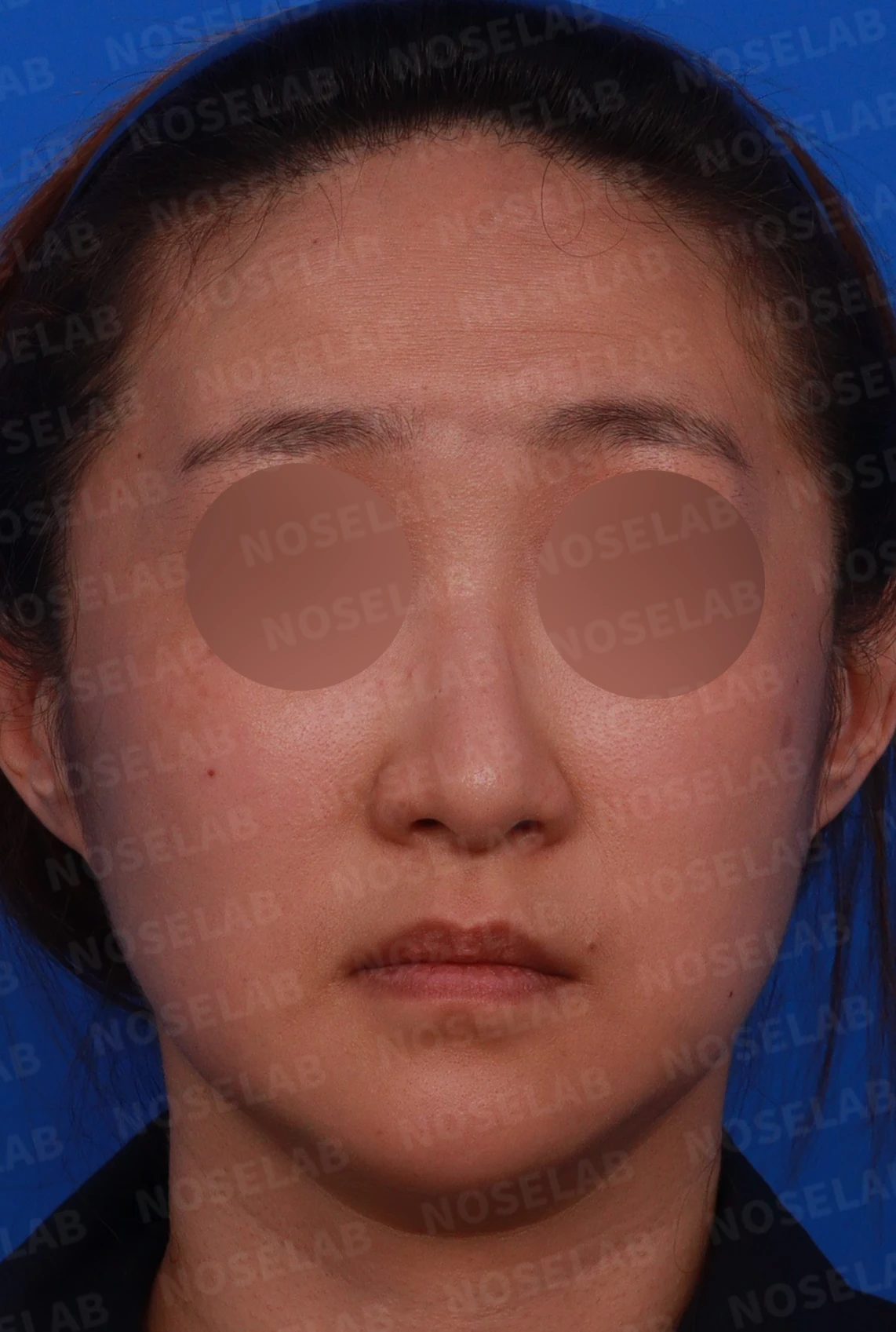코가 한쪽으로 휘어 보이고 밤에 막히는 이유, 비중격 재건과 코막힘 개선 — 디자인 상담 정면 , 좌측 비스듬한 측면 , 측면 사진입니다.