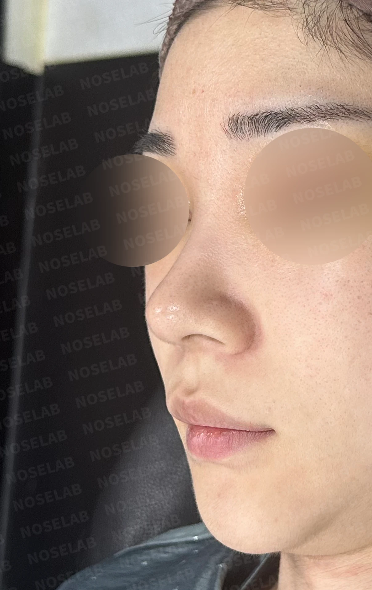 코가 뭉툭하고 퍼져 보이는 이유, 비순각과 비주는 어떻게 교정하나 — 수술 전 / 수술 직후 0일 직후 사진은 부기가 있는 상태로 최종 결과와 다를 수 있습니다.