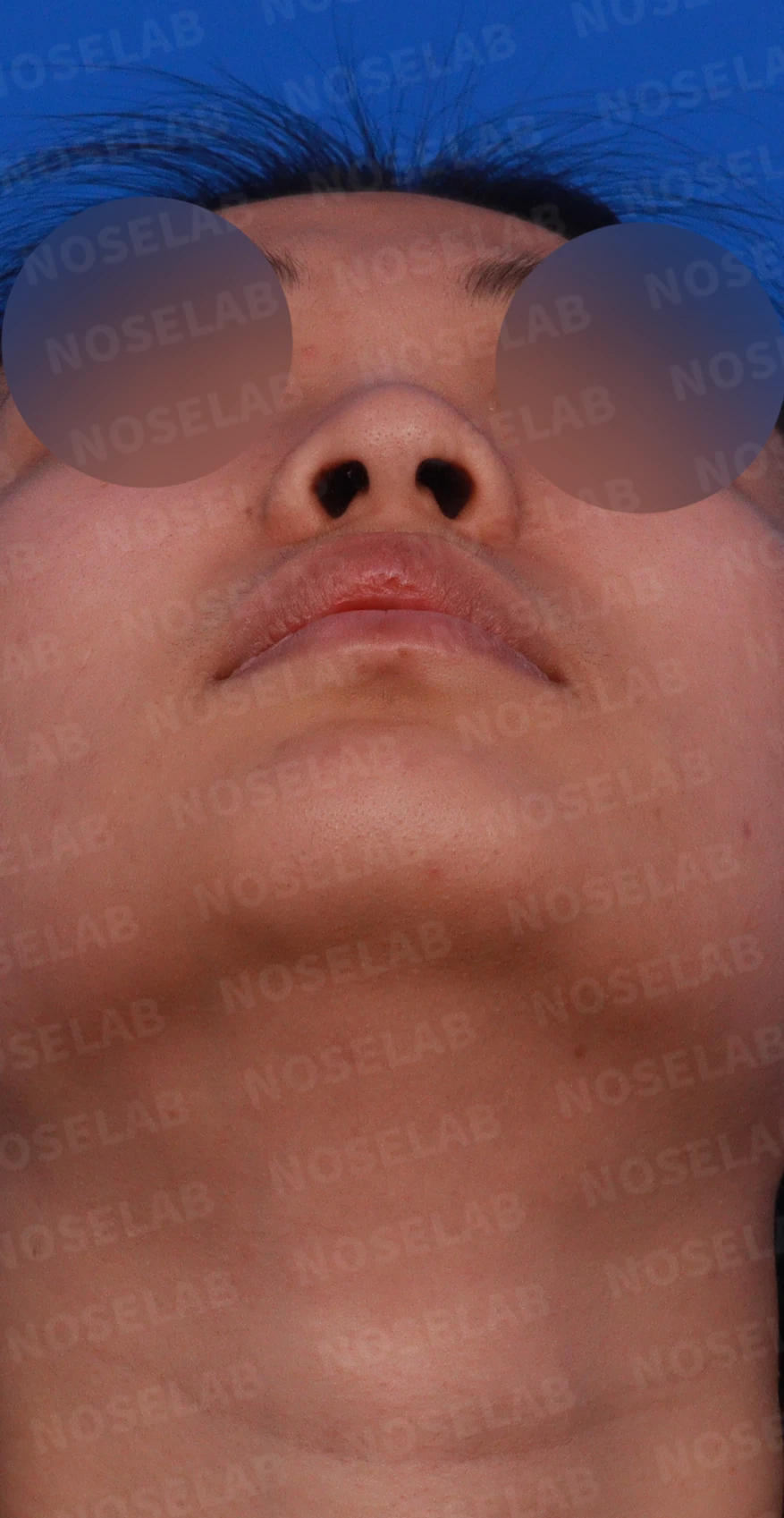뭉툭하게 퍼진 코끝이 생기는 이유, 자가 늑연골 비중격 연장으로 직반 라인을 만드는 방법 — 디자인 상담 우측 측면, 비스듬한 측면, 비공 사진