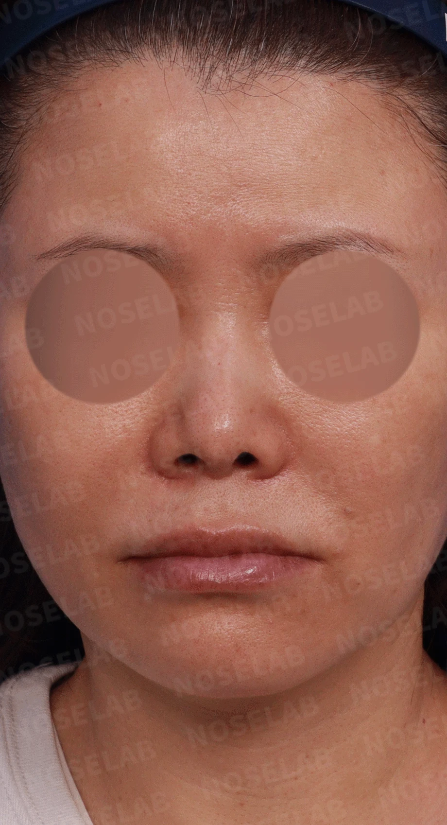 오래된 실리콘이 코끝에서 비쳐 보이는 이유와 제거·재건 방법 — 디자인 상담 정면, 좌측 측면, 비스듬한 측면 사진