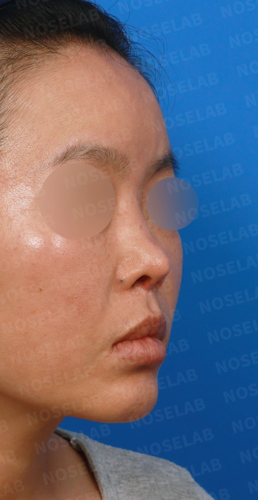 이식한 진피가 흡수되어 콧대가 퍼지고 코가 들려 보이는 이유와 교정 방법 — 디자인 상담 우측 측면, 비스듬한 측면, 비공 사진입니다.