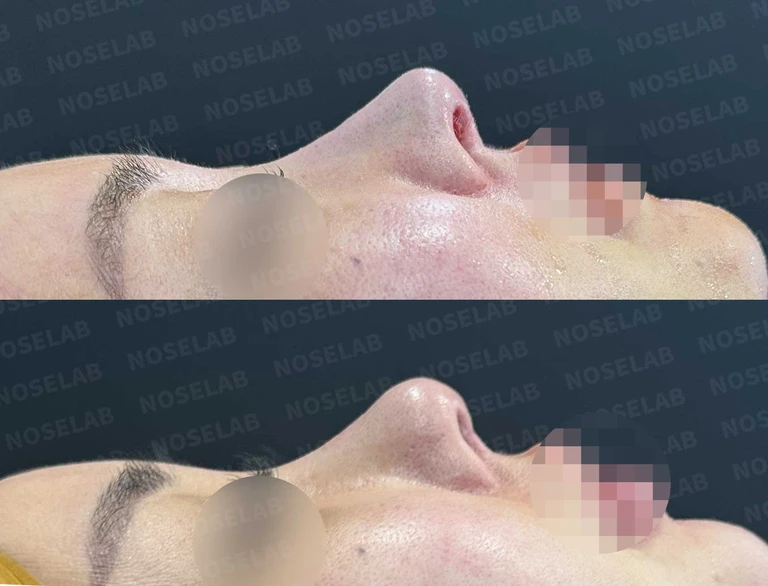 복 코 + 퍼진 코 + 휜 코 + 콧구멍 비대칭 교정 재수술(자가늑연골) — 전후 비교