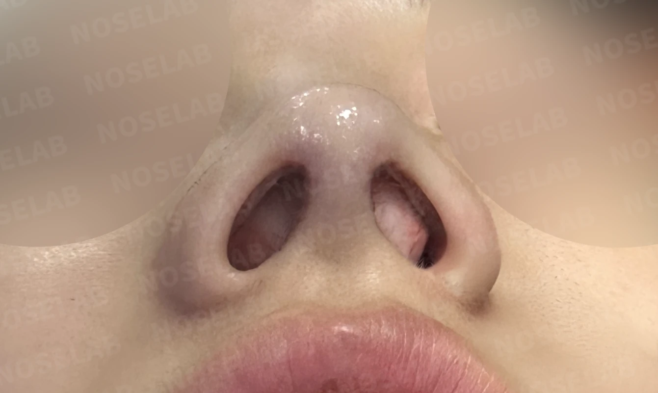 무보형물 코성형, 휘어진 콧대와 처진 코끝을 자연스럽게 교정 — 전(좌) 직후(후)