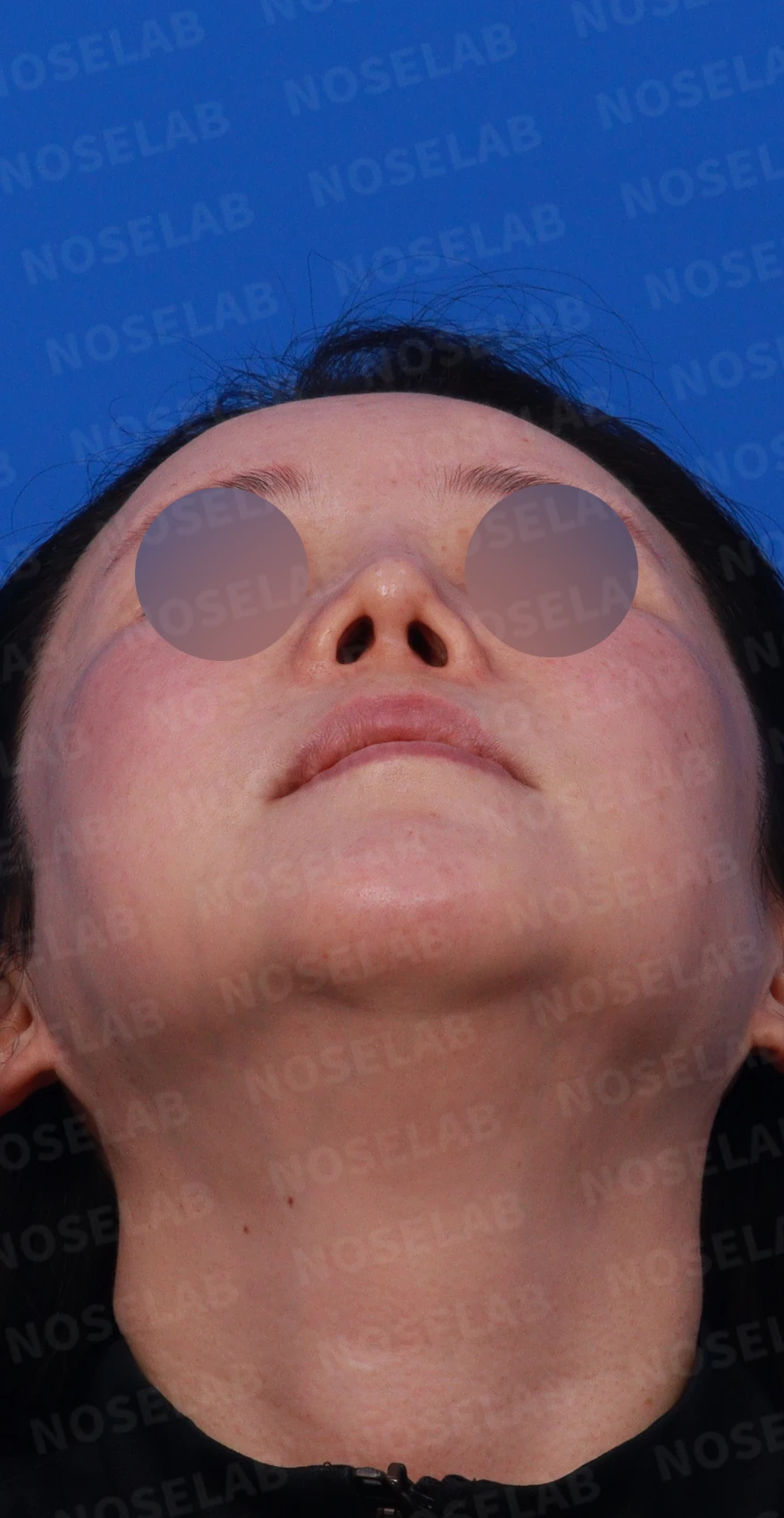 귀족수술 보형물이 코 안으로 밀려 나와 숨이 막히는 이유와 재건 방법 — 디자인 상담 우측 비스듬한 측면, 측면, 비공 사진입니다.