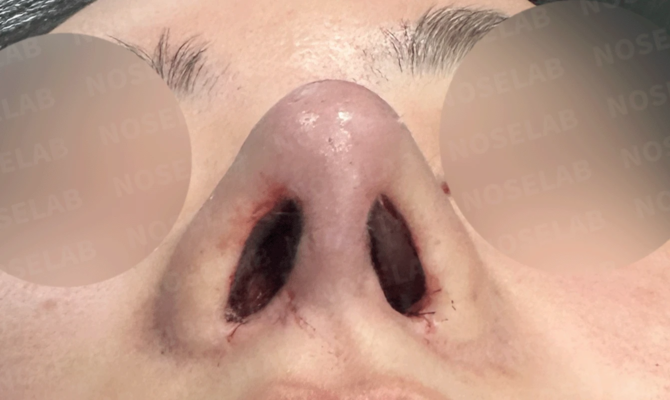 코가 과하게 높아져 부자연스러워 보이고 휘는 이유, 재건은 어떻게 하나 — 수술 전 / 수술 직후 0일 직후 사진은 부기가 있는 상태로 최종 결과와 다를 수 있습니다.