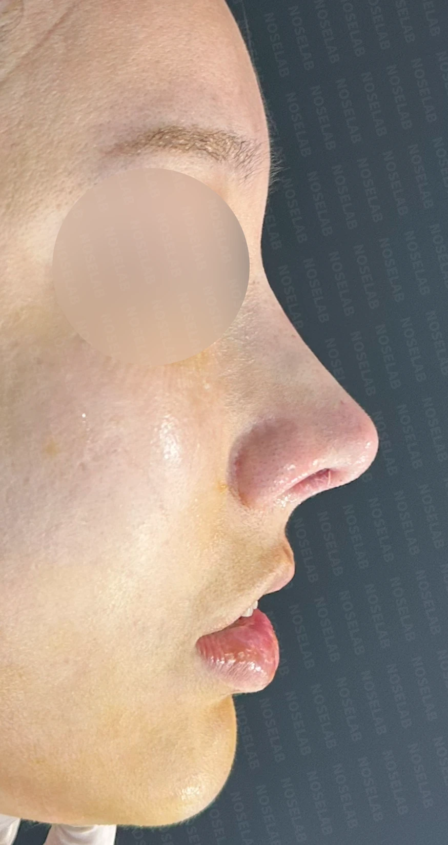 휜코와 콧구멍 비대칭, 호흡을 함께 고려한 교정 방법 — 수술 직후 0일 정면, 비스듬한 측면, 측면 사진입니다. 직후 사진은 부기가 있는 상태로 최종 결과와 다를 수 있습니다.