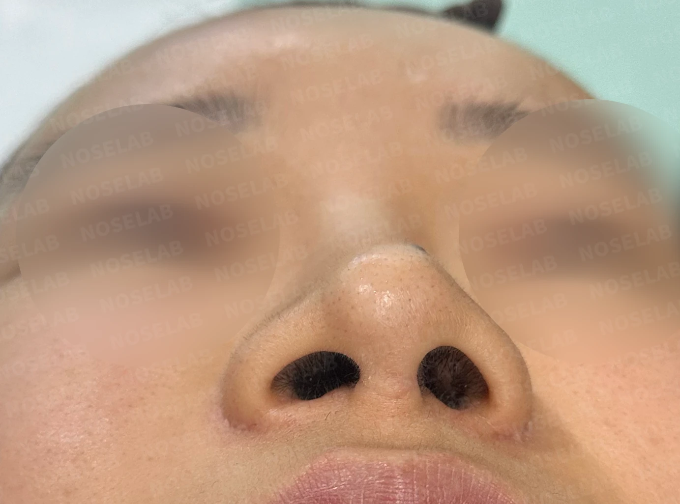 비공 비대칭, 퍼진코! 코재수술 사례 — 전(좌) 직후(우)