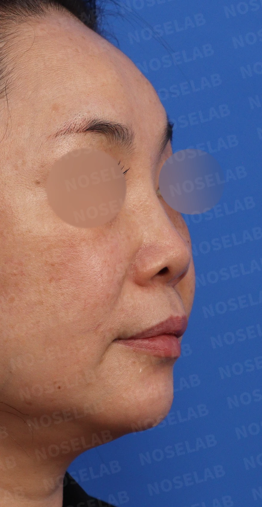 작고 들린 코에서 필러 제거와 교정을 계획하는 방법 — 디자인 정면, 비스듬한 측면, 측면 사진